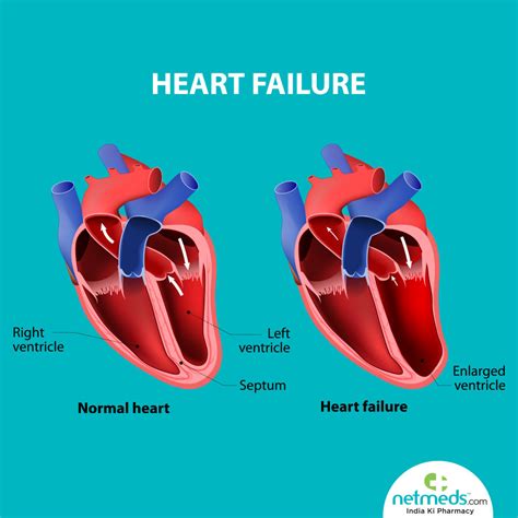 lv function impaired|treatment for left ventricular dysfunction.